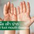 โรค มือ เท้า ปาก Hand foot mouth disease